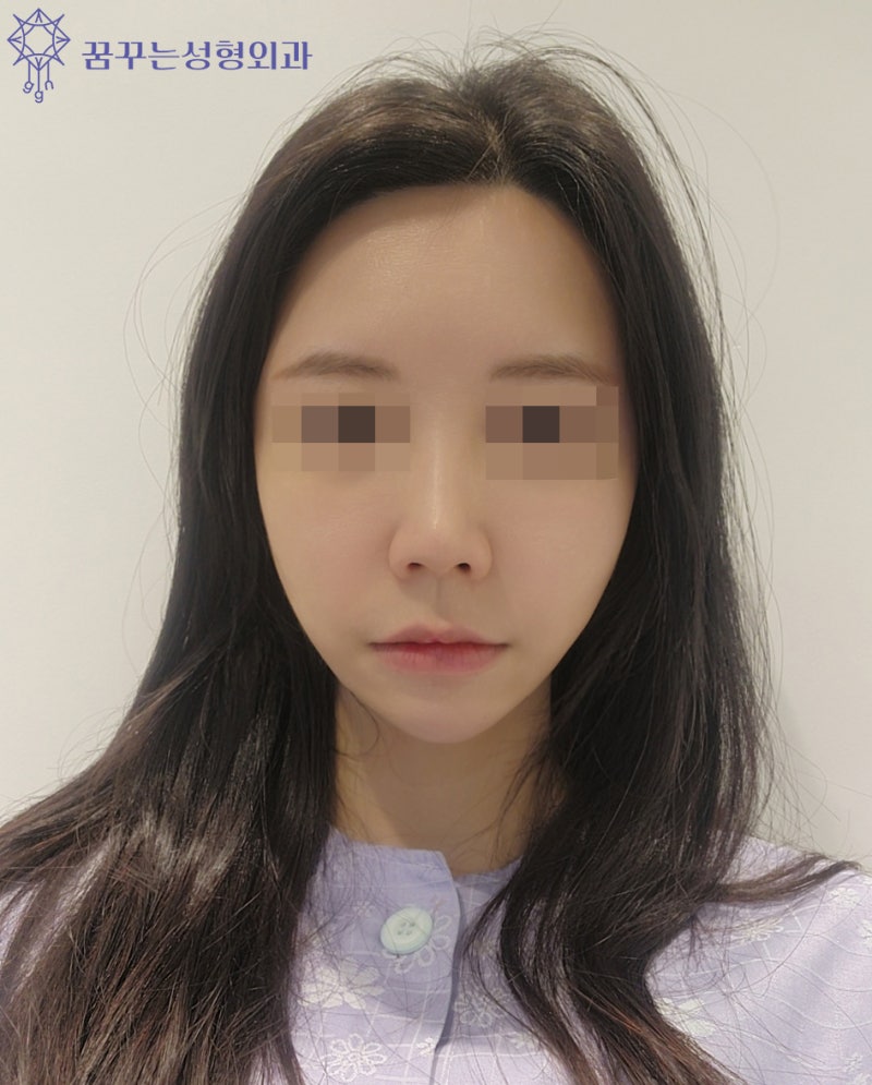 강남 피부관리 티타늄 리프팅 어떤가요? 사진 4