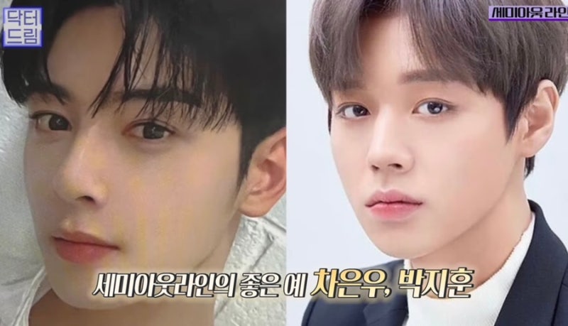 [강남꿈꾸는성형외과] 연예인으로 보는 2023 남자 눈 성형 트렌드 사진 11