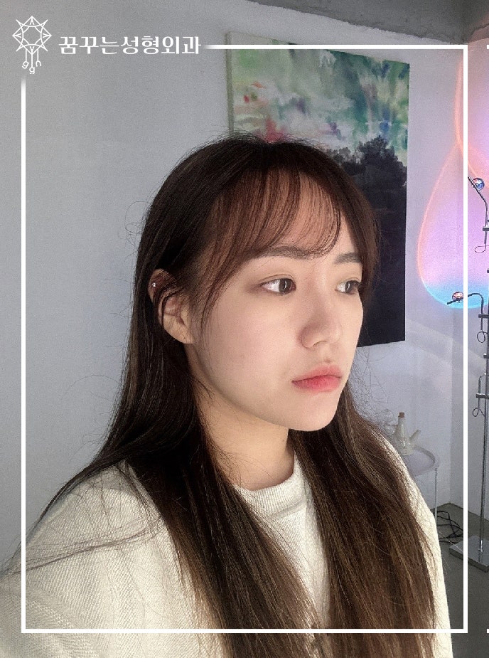 [강남 꿈꾸는성형외과] 화이트닝, 타이트닝, 리프팅 모두를 잡은 피부관리 - 티타늄 레이저 리프팅 사진 5