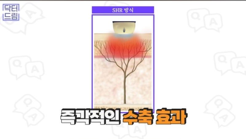 2023결산_ 가장 인기많은 핫한 레이저는? 사진 26