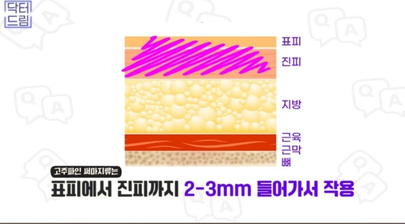 2023결산_ 가장 인기많은 핫한 레이저는? 사진 9