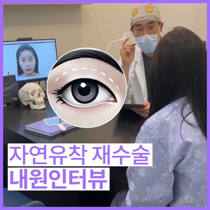 쌍꺼풀수술을 하는데에 고려할 사항 [꿈꾸는성형외과]