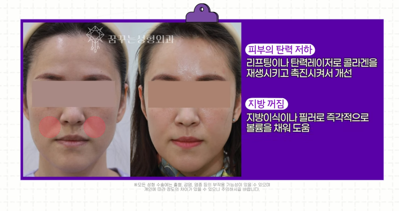 팔자주름 마리오네트주름 입가주름 해결법 사진 8