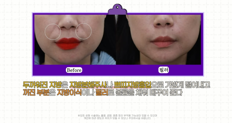 팔자주름 마리오네트주름 입가주름 해결법 사진 12