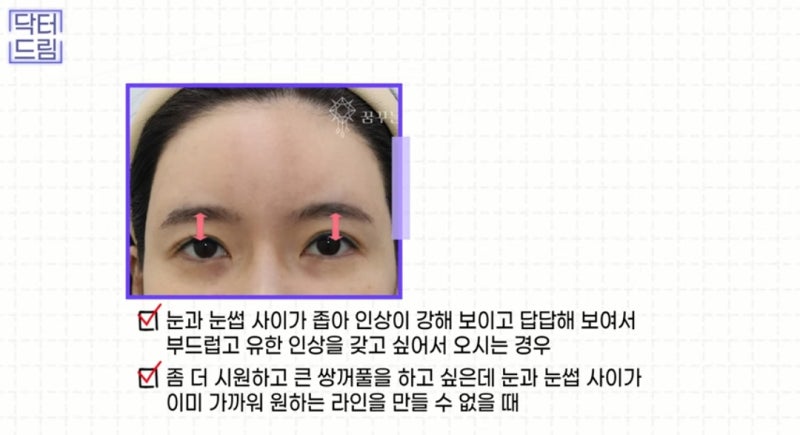 힙한 mz는 다 알고있는 이마리프팅 사진 12