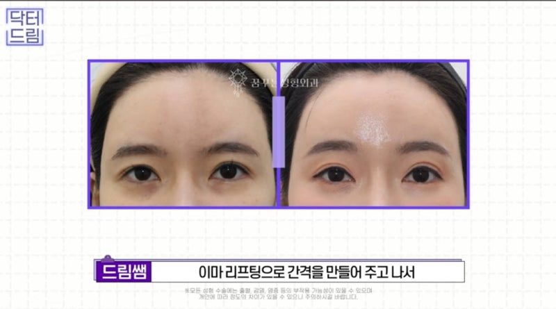 힙한 mz는 다 알고있는 이마리프팅 사진 13