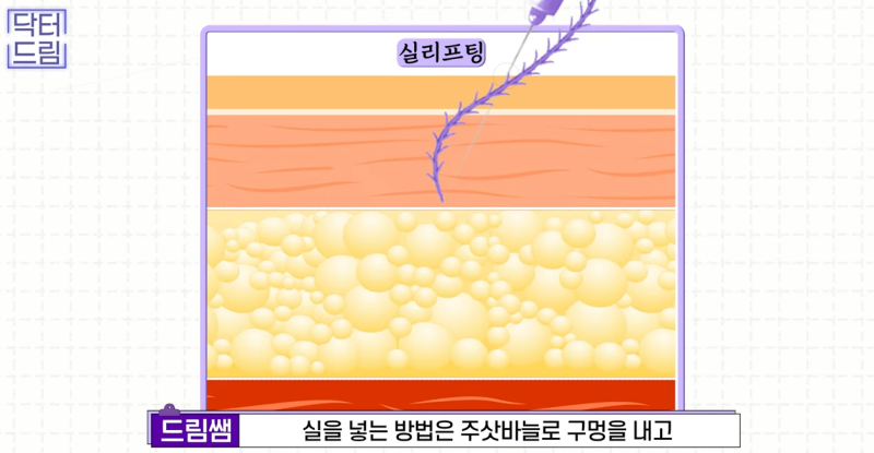 실리프팅 해 본 사람만 알 수 있는 비밀 사진 17