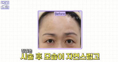 눈꺼풀이 쑥 꺼지고 퀭한 눈위꺼짐 해결법 (지방이식,필러) 사진 22