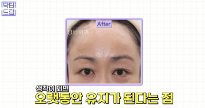 눈꺼풀이 쑥 꺼지고 퀭한 눈위꺼짐 해결법 (지방이식,필러) 사진 23