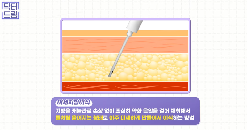 눈꺼풀이 쑥 꺼지고 퀭한 눈위꺼짐 해결법 (지방이식,필러) 사진 13