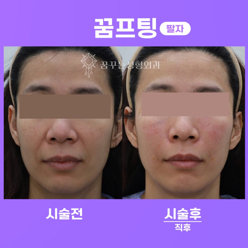 실리프팅, 그 효과와 매력- 강남 페이스 리프팅 꿈꾸는성형외과