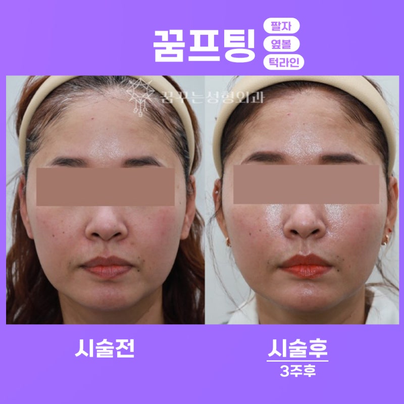 실리프팅, 그 효과와 매력- 강남 페이스 리프팅 꿈꾸는성형외과
