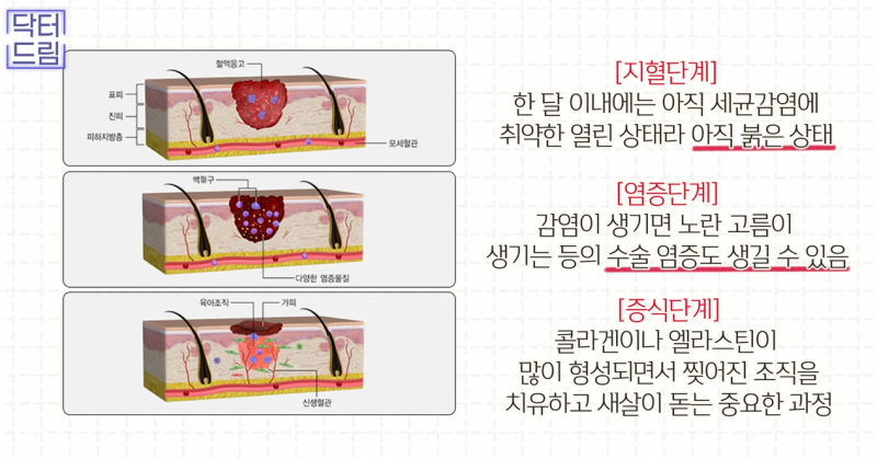 [강남역 성형외과] 켈로이드라서 쌍꺼풀 수술 고민하고 있다면 보세요. 흉터에 관한 모든걸 알려드려요 사진 13