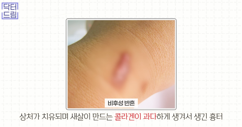 [강남역 성형외과] 켈로이드라서 쌍꺼풀 수술 고민하고 있다면 보세요. 흉터에 관한 모든걸 알려드려요 사진 5