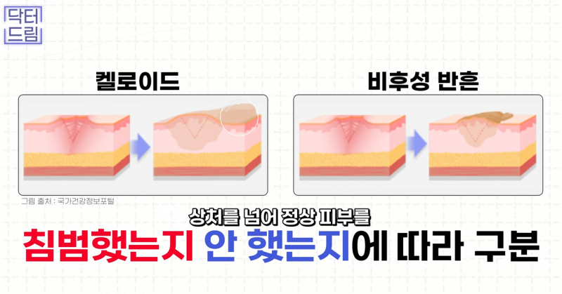 [강남역 성형외과] 켈로이드라서 쌍꺼풀 수술 고민하고 있다면 보세요. 흉터에 관한 모든걸 알려드려요 사진 18