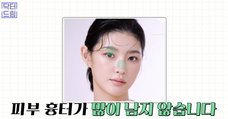 [강남역 성형외과] 켈로이드라서 쌍꺼풀 수술 고민하고 있다면 보세요. 흉터에 관한 모든걸 알려드려요 사진 6