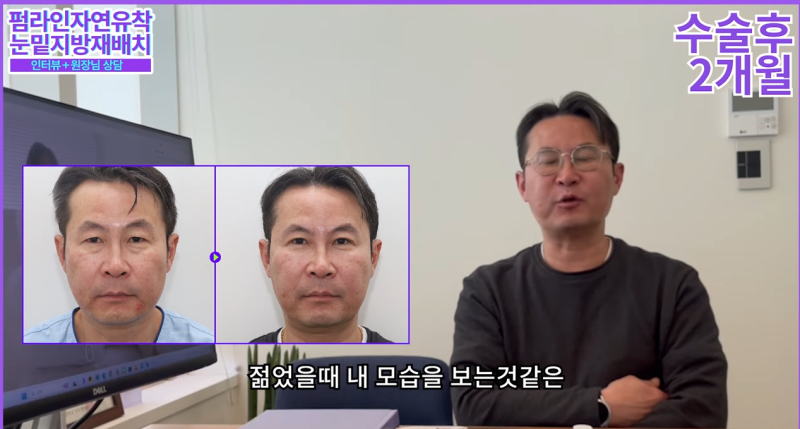 50대 중년 남자 노화고민 / 안티에이징 수술 솔직후기 사진 11