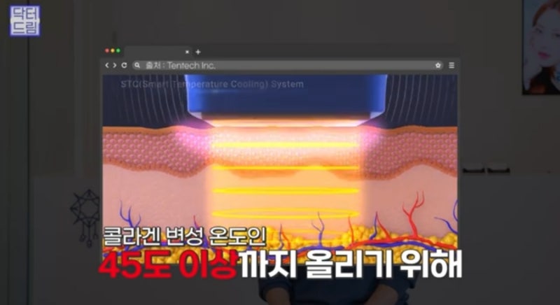 안아프고 안비싸고 효과는 확실한 레이저! 있습니다 ! 사진 34