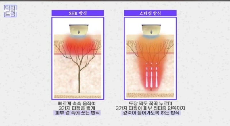 안아프고 안비싸고 효과는 확실한 레이저! 있습니다 ! 사진 24