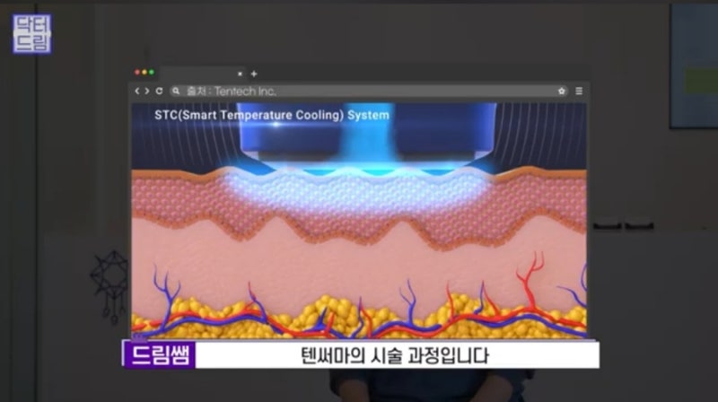 안아프고 안비싸고 효과는 확실한 레이저! 있습니다 ! 사진 32