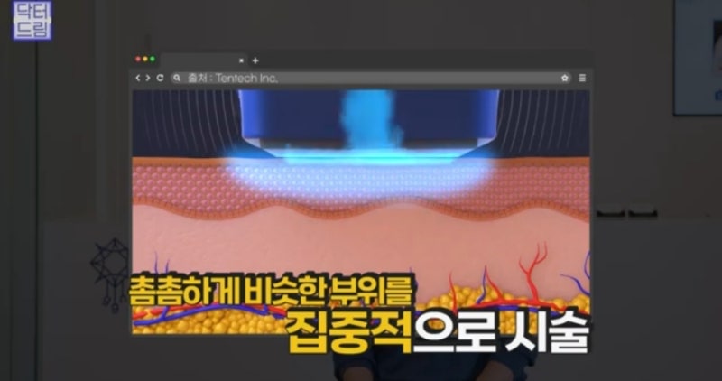 안아프고 안비싸고 효과는 확실한 레이저! 있습니다 ! 사진 37