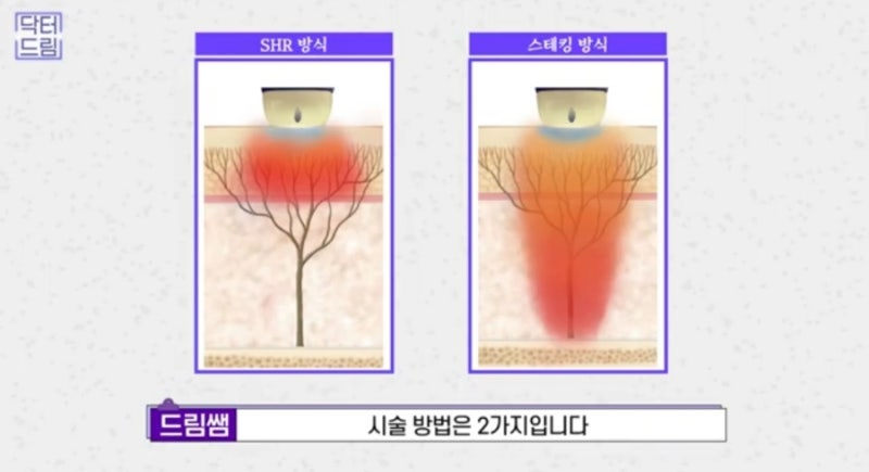 안아프고 안비싸고 효과는 확실한 레이저! 있습니다 ! 사진 23