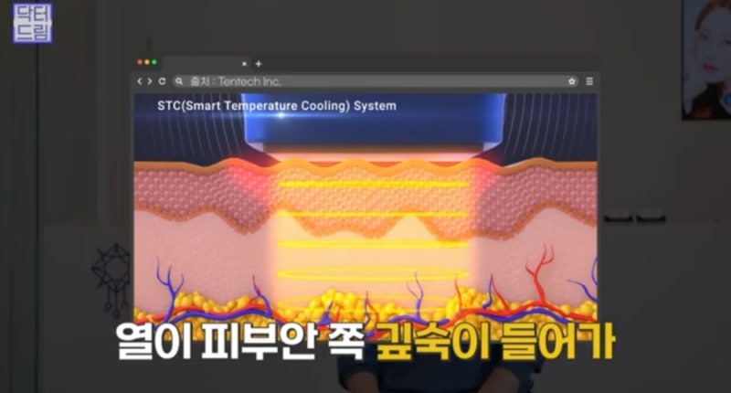 안아프고 안비싸고 효과는 확실한 레이저! 있습니다 ! 사진 33