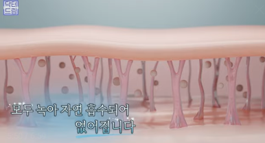 [강남역 성형외과] 이거 모르면 보톡스, 필러 맞았다가 후회합니다 사진 47