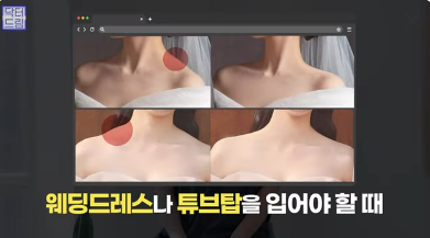 [강남역 성형외과] 이거 모르면 보톡스, 필러 맞았다가 후회합니다 사진 10