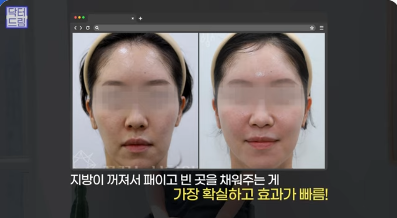 [강남역 성형외과] 이거 모르면 보톡스, 필러 맞았다가 후회합니다 사진 34
