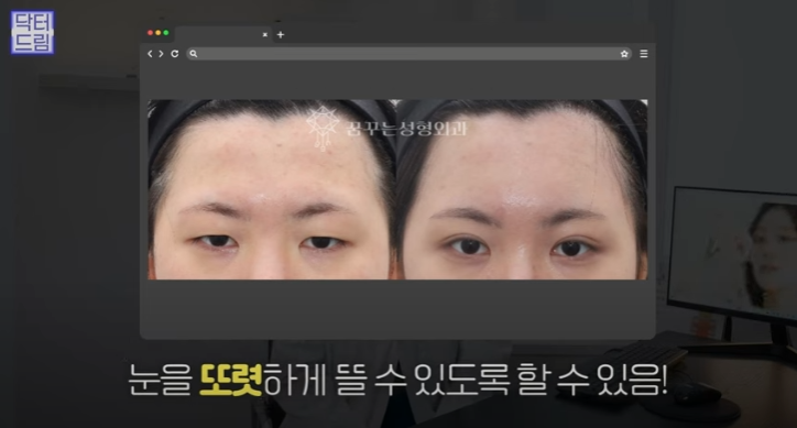 쌍꺼풀하면 대박나는 4가지 유형 사진 14
