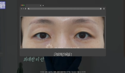 [강남역성형외과] 성형외과 처음갈 때 망하고 싶지 않으면 보세요 (상담꿀팁, 병원선택기준) 사진 22