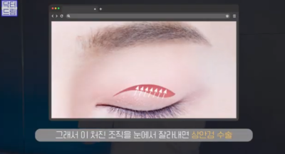 [강남역 성형외과] 깊어져만 가는 이마주름이 고민이라면 이것을 하세요 사진 17