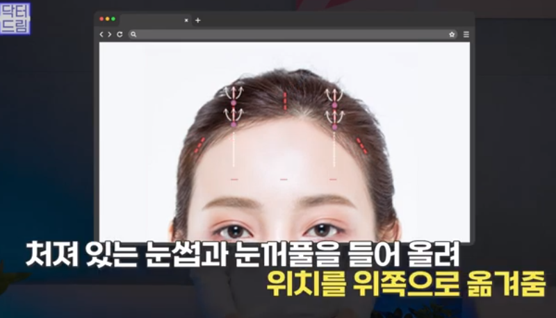 [강남역 성형외과] 깊어져만 가는 이마주름이 고민이라면 이것을 하세요 사진 24