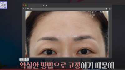 [강남역 성형외과] 깊어져만 가는 이마주름이 고민이라면 이것을 하세요 사진 29