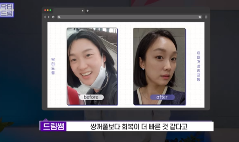 [강남역 성형외과] 깊어져만 가는 이마주름이 고민이라면 이것을 하세요 사진 36