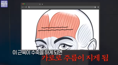 [강남역 성형외과] 깊어져만 가는 이마주름이 고민이라면 이것을 하세요 사진 7