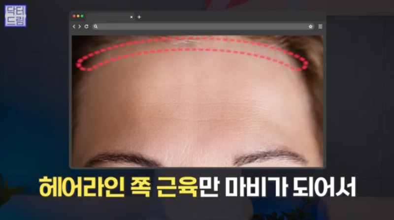 [강남역 성형외과] 깊어져만 가는 이마주름이 고민이라면 이것을 하세요 사진 15