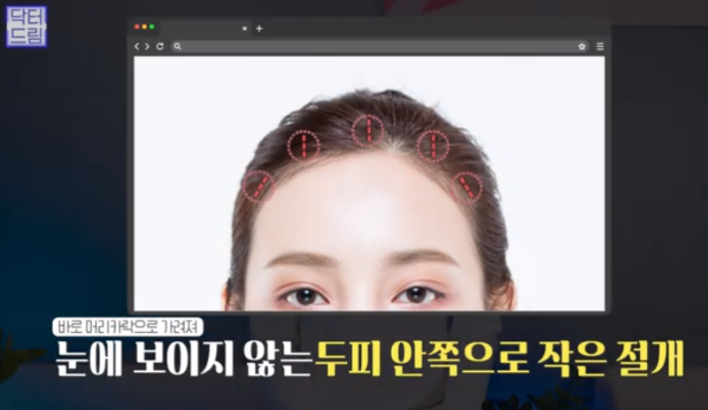 [강남역 성형외과] 깊어져만 가는 이마주름이 고민이라면 이것을 하세요 사진 23