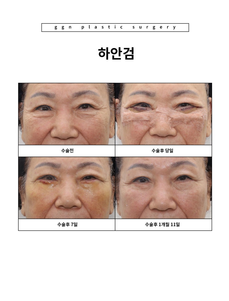 [강남역성형외과] "부모님 추석 선물 추천: 젊음을 되찾아 드리기" 사진 10