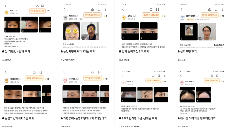 [신논현성형외과] 꿈꾸는 성형외과에서 경험한 쁘띠 성형과 티타늄 레이저 후기: 일본인 관광 시술 후기
