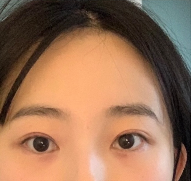 [강남역성형외과] 내려오는 이마, 처지는 눈이 고민이라면 : 내시경 이마거상술(엔도타인) 후기 사진 6