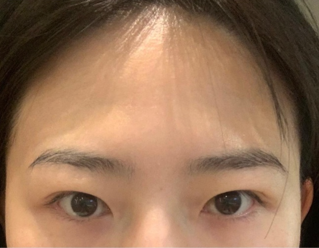 [강남역성형외과] 내려오는 이마, 처지는 눈이 고민이라면 : 내시경 이마거상술(엔도타인) 후기