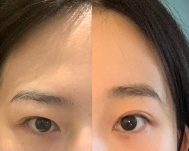 [강남역성형외과] 내려오는 이마, 처지는 눈이 고민이라면 : 내시경 이마거상술(엔도타인) 후기 사진 5