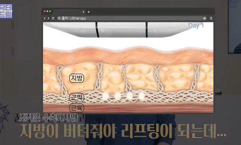 [강남역 성형외과] 닥터드림이 알려주는 내 얼굴에 딱 맞는 레이저 고르기 /레이저 오래가는 법 사진 9