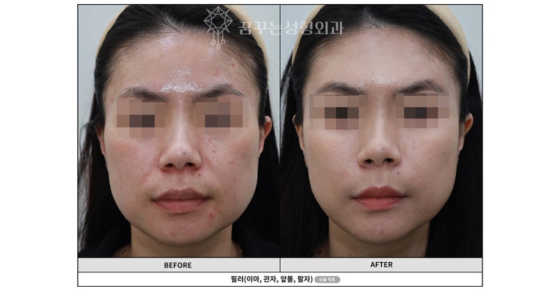 [강남역성형외과] 필러 시술, 어디서 받을지 고민 중이신가요? 사진 5