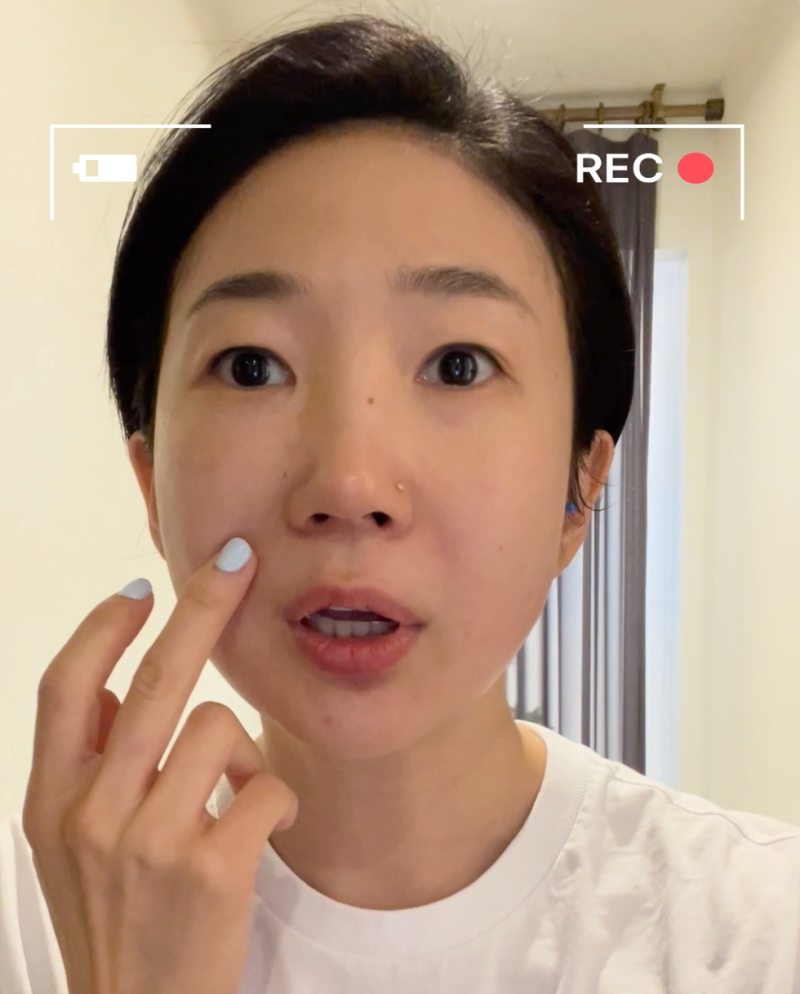 [강남역성형외과] 울쎄라와 티타늄 레이저를 번갈아 받은 후기 사진 4