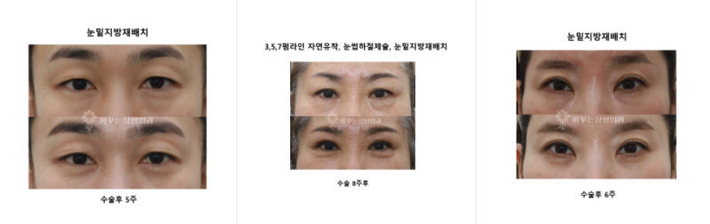 [강남역성형외과] 눈밑 꺼짐으로 다크써클, 얼굴이 어두워 보인다면? 사진 4