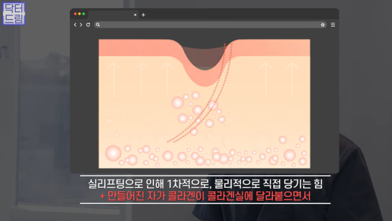 실리프팅 가장 효과 좋은 나이/ 실리프팅 몇살부터 하나요? 사진 13