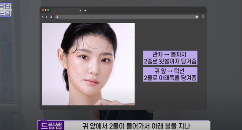 실리프팅 가장 효과 좋은 나이/ 실리프팅 몇살부터 하나요? 사진 19